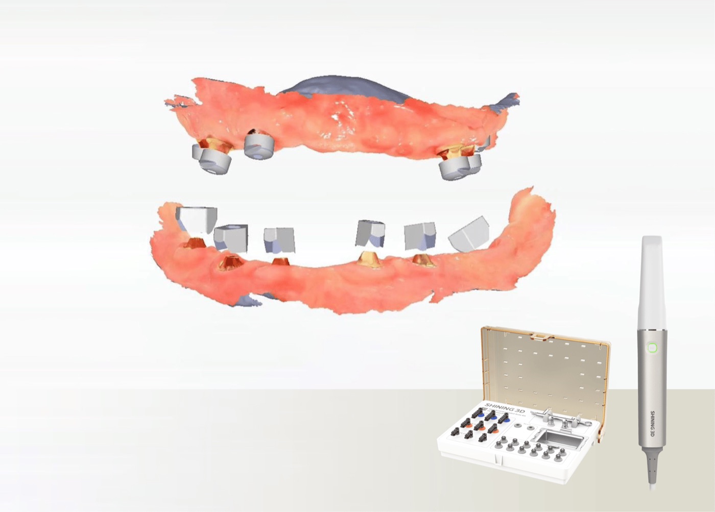 Empreinte d’une arcade complète sur implants avec photogrammétrie